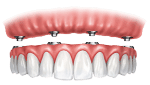 Screw Retained Dentures
