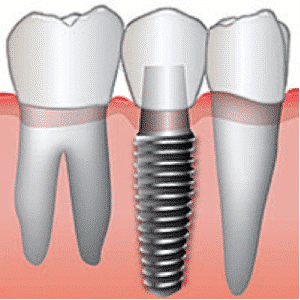 dental implant cost