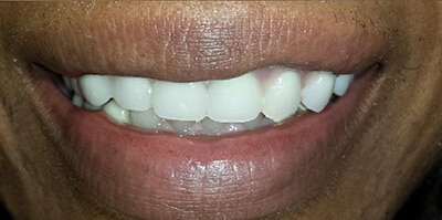 After Dentures with Ocean Dentistry Co Team in NJ