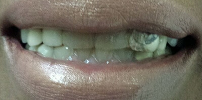 Before Dentures with Ocean Dentistry Co Team in NJ