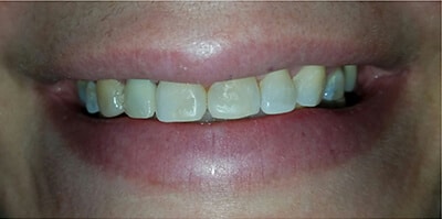After Dental Implants with Ocean Dentistry Team in New Jersey
