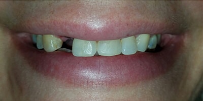 Before Dental Implants with Ocean Dentistry Team in New Jersey