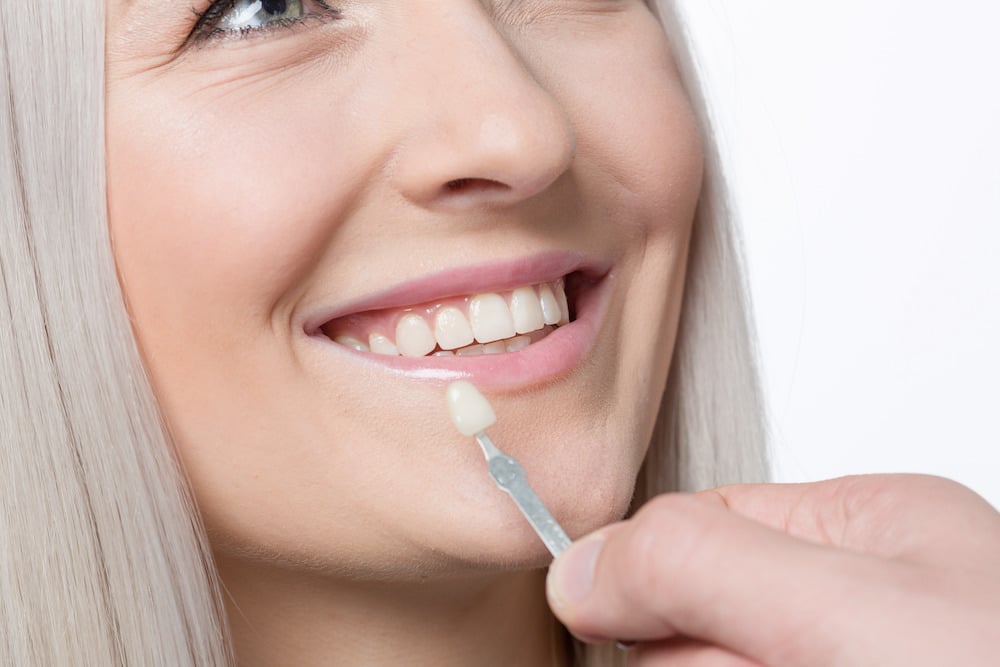 How Much Do Veneers Cost?
