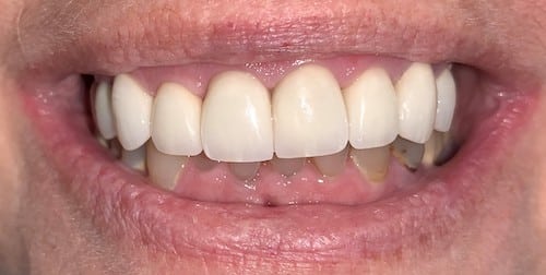 After a smile makeover with Ocean Dentistry Co Team in New Jersey