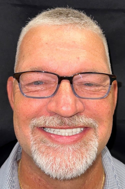 After a smile makeover with Ocean Dentistry Co Team Township NJ