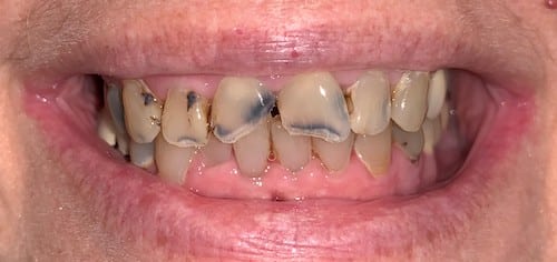 Before a smile makeover with Ocean Dentistry Co Team in New Jersey