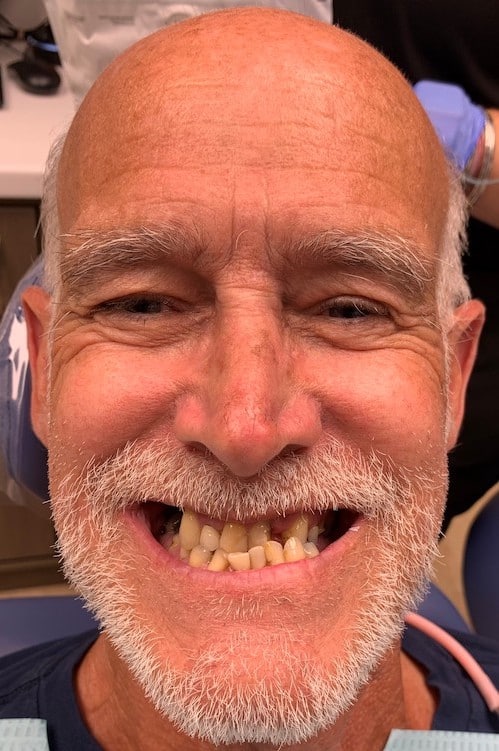 Before a smile makeover with Ocean Dentistry Co Team in New Jersey