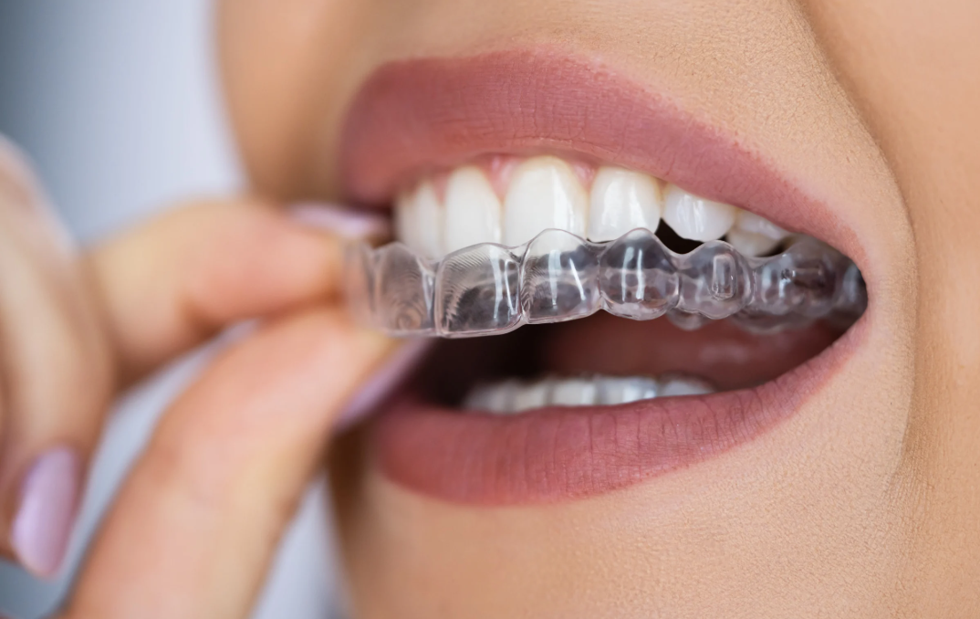 Custom-Fitted Dental Mouth Guard in Ocean Township NJ