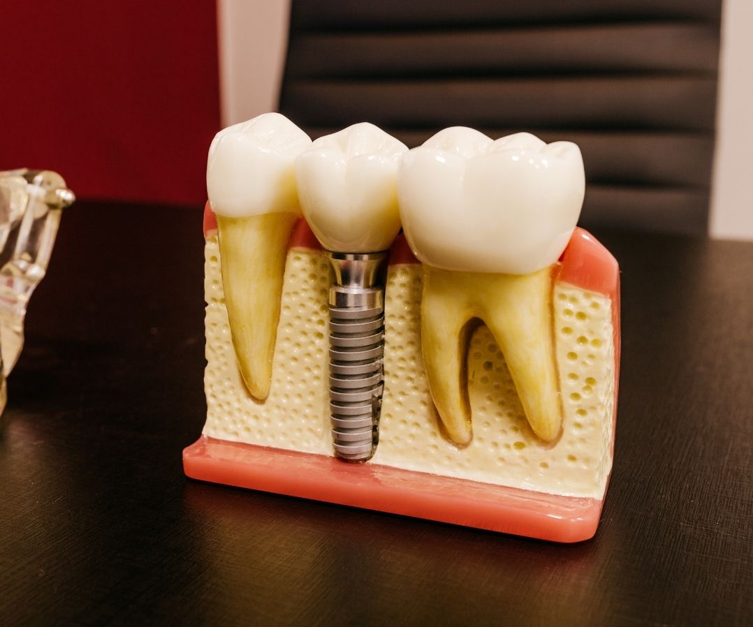 Dental implants are modern, efficient and the most sensible alternative to natural teeth