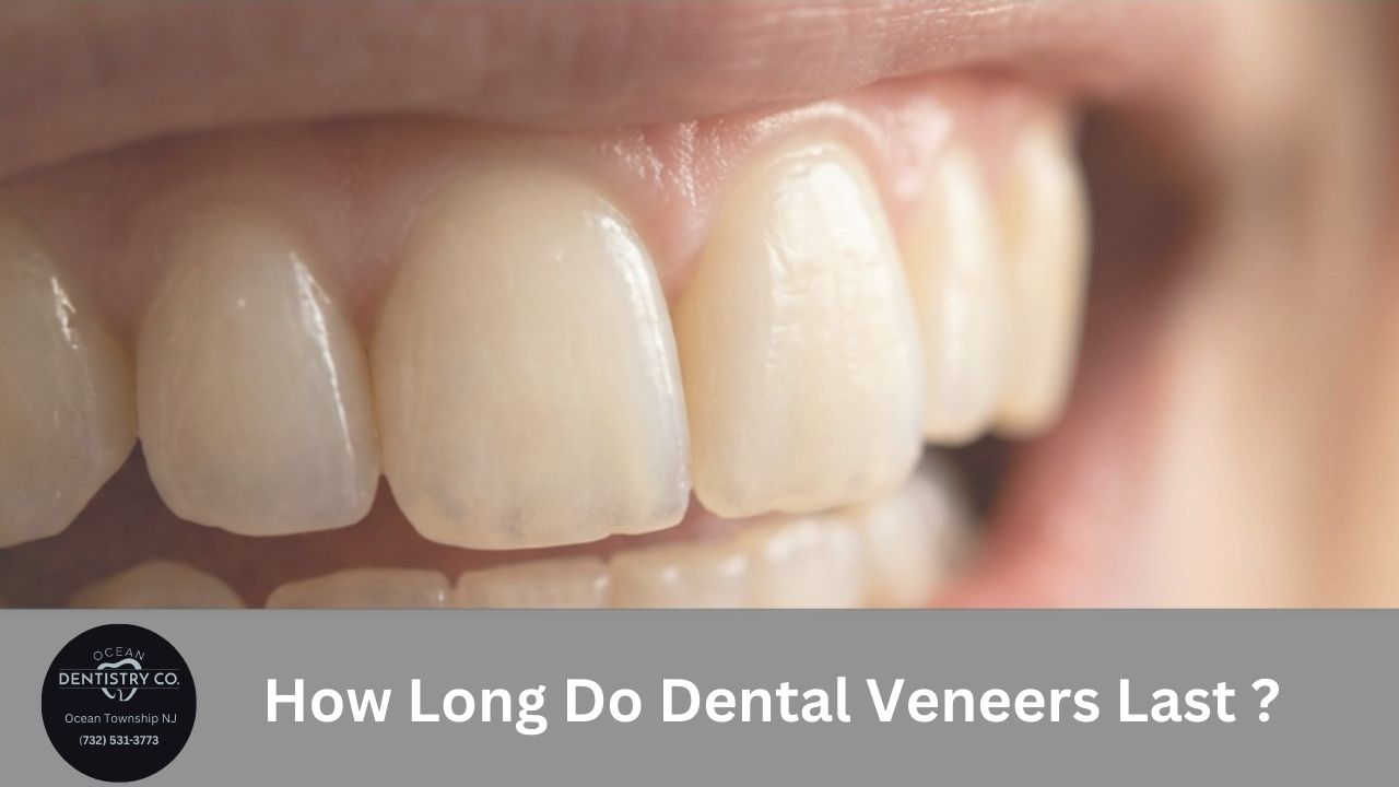 How Long Do Dental Veneers Last And What Actually Affects Them