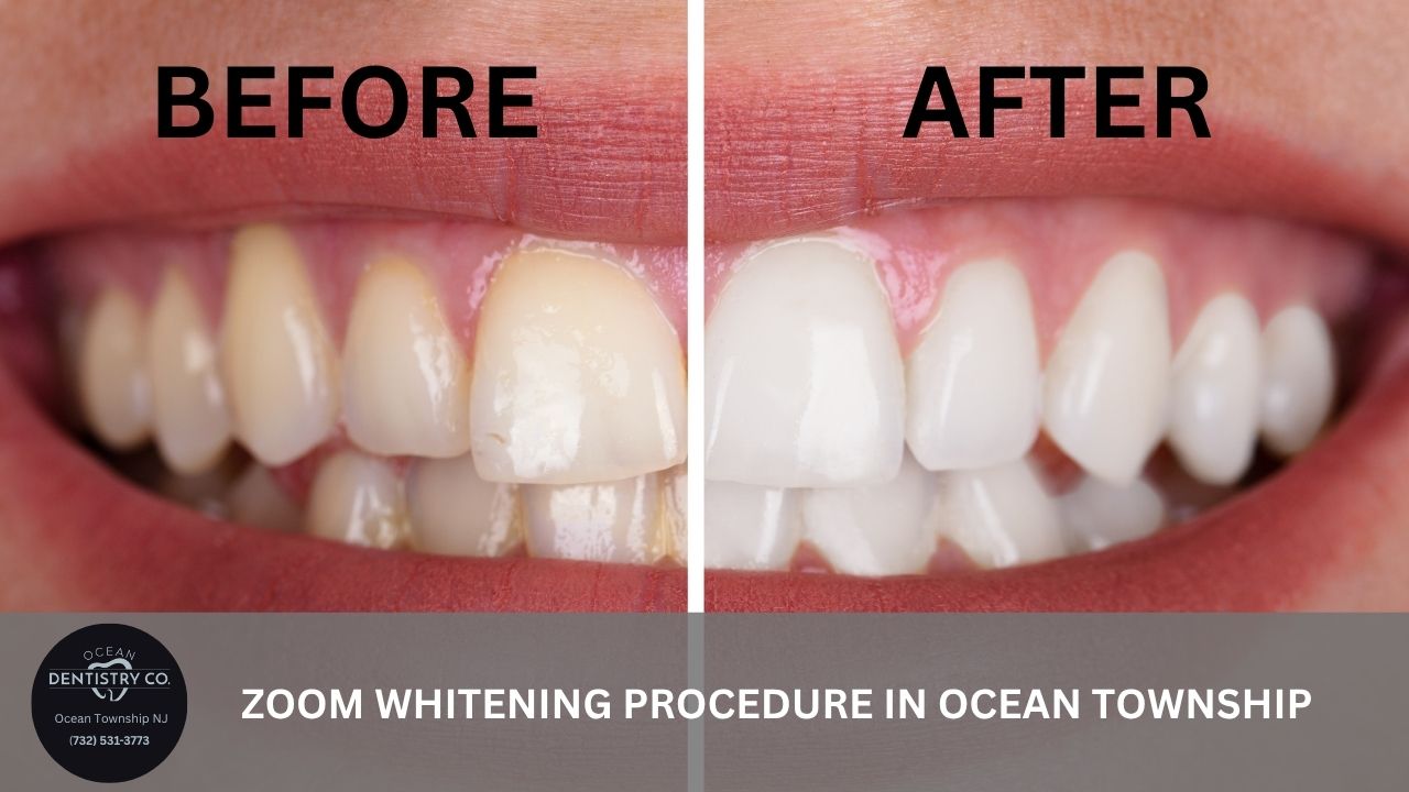 Zoom Whitening Procedure Ocean Dentistry